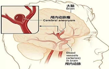 突发头晕呕吐，竟是因为脑子里的这枚“不定时炸弹”……